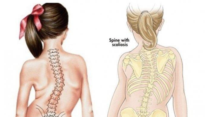Kebiasaan Sehari Hari Juga Bisa Menyebabkan Skoliosis