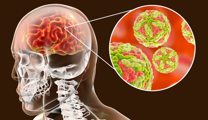 Ensefalitis Penyakit Peradangan Pada Jaringan Otak
