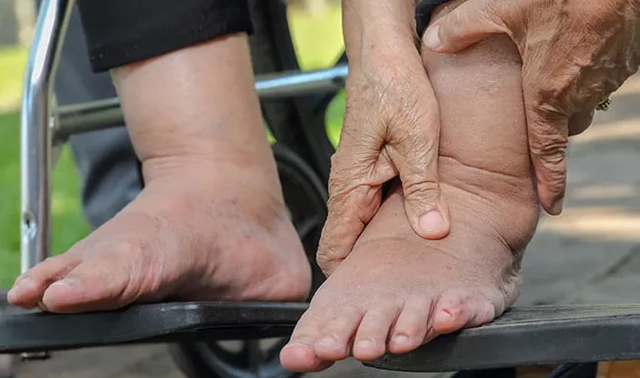 Kaki Gajah Yang Di Sebabkan Infeksi Cacing Filaria