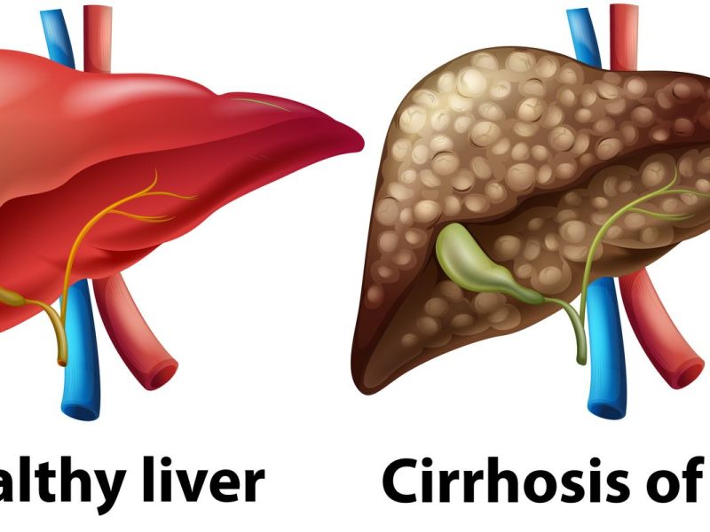 Kanker Hati Tanpa Operasi: Jenis Mana Yang Bisa Sembuh?