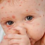 Kasus Bayi Baru Lahir Terkena Cacar Air, Apa Risikonya?