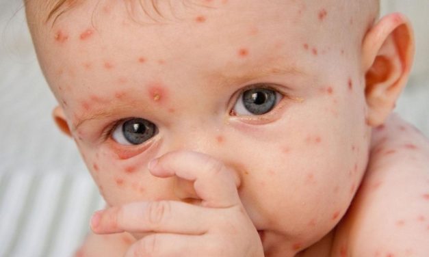 Kasus Bayi Baru Lahir Terkena Cacar Air, Apa Risikonya?