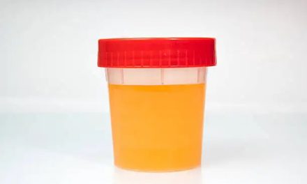 Alkaptonuria, Kelainan Genetik Langka Mengubah Warna Urine