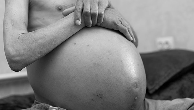 Asites, Penumpukan Cairan Di Rongga Perut Perlu Di Waspadai