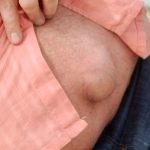 Penyakit Hernia Kenali Gejala Yang Paling Sering Muncul