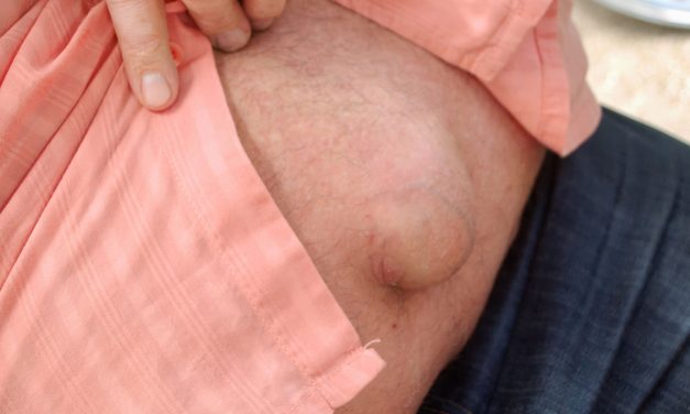 Penyakit Hernia Kenali Gejala Yang Paling Sering Muncul