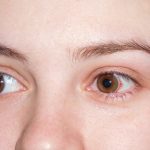 Xerophthalmia, Gangguan Mata Akibat Kekurangan Vitamin A