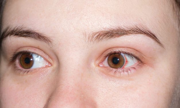 Xerophthalmia, Gangguan Mata Akibat Kekurangan Vitamin A