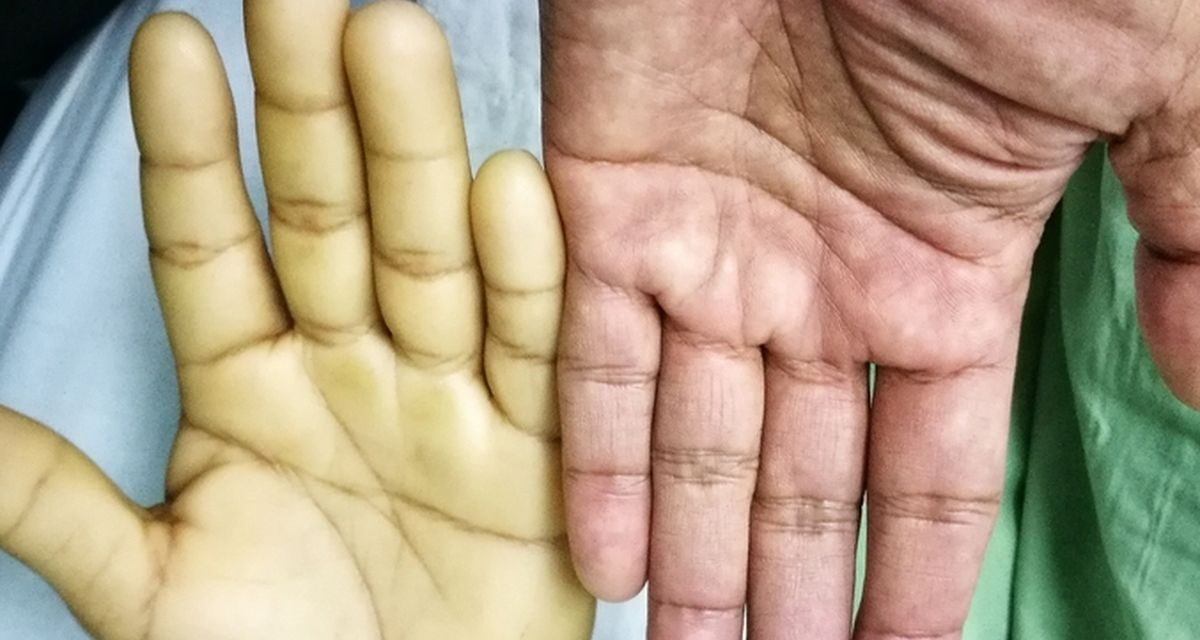 Penyakit Anemia Kondisi Tubuh Kekurangan Sel Darah Merah