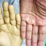 Penyakit Anemia Kondisi Tubuh Kekurangan Sel Darah Merah