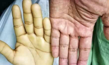 Penyakit Anemia Kondisi Tubuh Kekurangan Sel Darah Merah