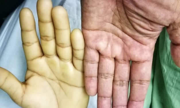 Penyakit Anemia Kondisi Tubuh Kekurangan Sel Darah Merah